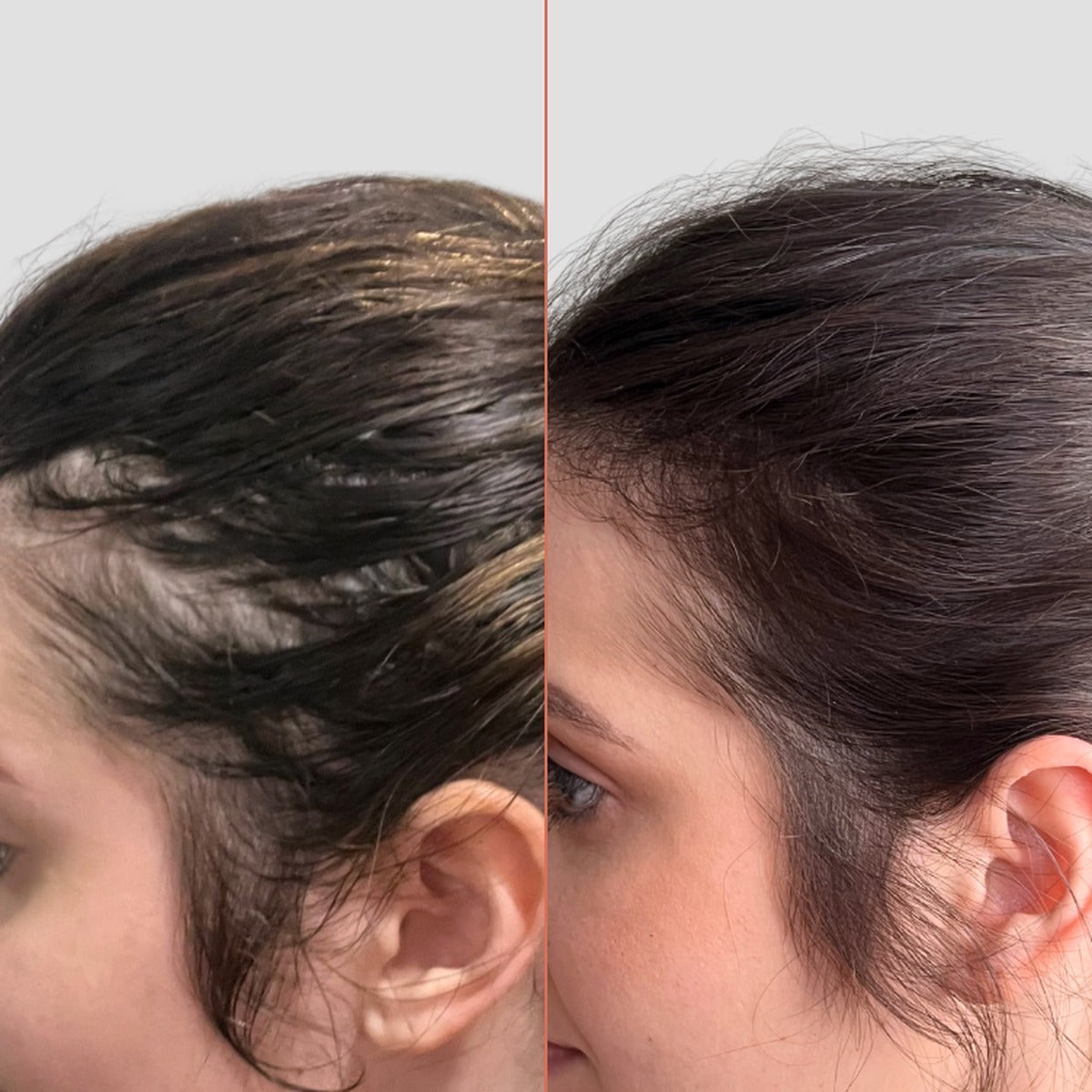 Hair loss, fine hair, weak hair